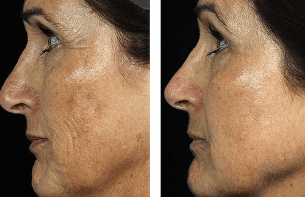 Prije i poslije frakcijskog pomlađivanja lica
