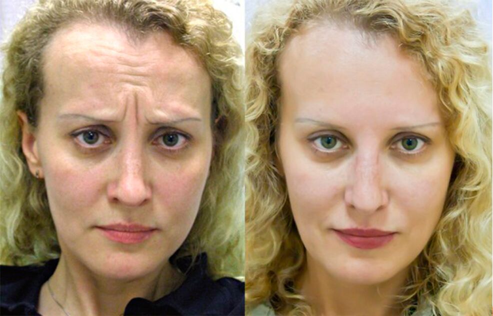 prije i poslije korištenja masažera za pomlađivanje ltza fotografija 1