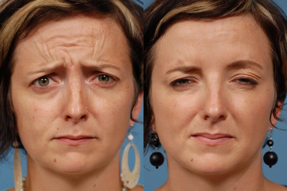 prije i poslije korištenja masažera za pomlađivanje ltza fotografija 2