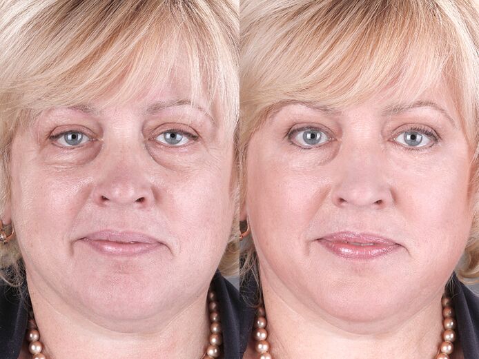 prije i poslije korištenja masažera za pomlađivanje ltza fotografija 3