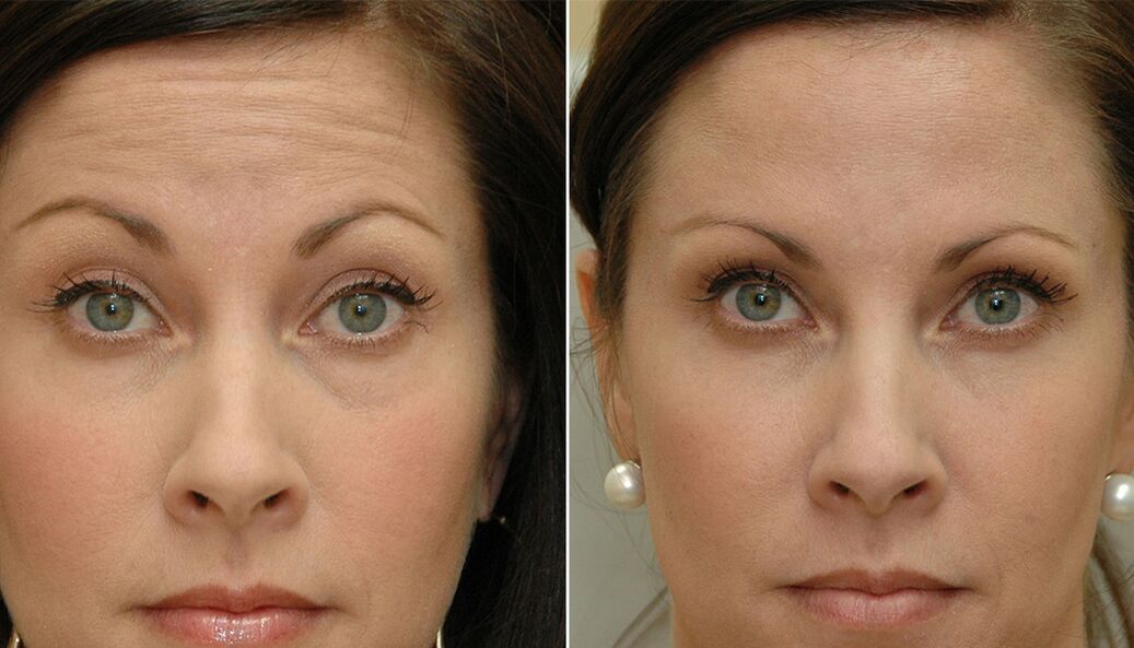 prije i poslije korištenja masažera za pomlađivanje ltza fotografija 4