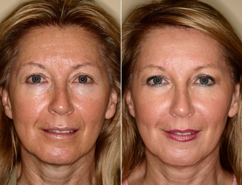 prije i poslije korištenja masažera za pomlađivanje ltza fotografija 5