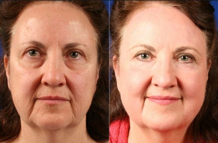 prije i poslije korištenja masažera za pomlađivanje ltza fotografija 6