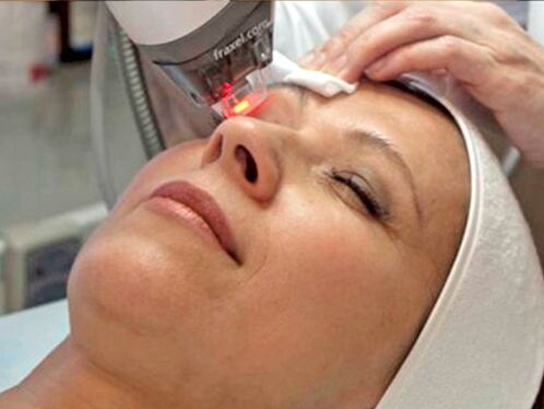 lasersko pomlađivanje kože oko očiju