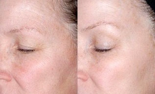pomlađivanje kože oko očiju prije i nakon fotografija