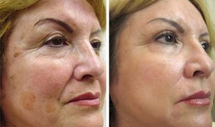 frakcijsko pomlađivanje kože prije i poslije fotografija
