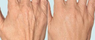Koža ruku prije i nakon frakcijske terapije