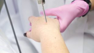 Lasersko pomlađivanje kože ruku