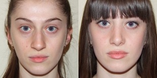 prije i poslije podmlađivanja kože u plazmi